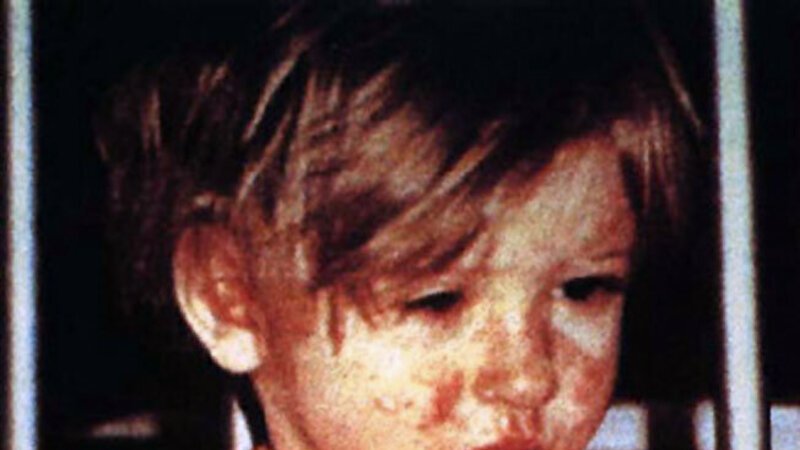 Measles rash — cases hit a 30-year high after RFK Jr. dismantled the vaccine system